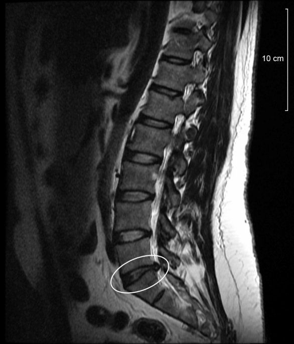 Osteopatía para tu hernia discal