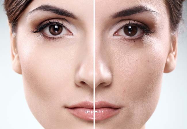 Qué es la radiofrecuencia facial