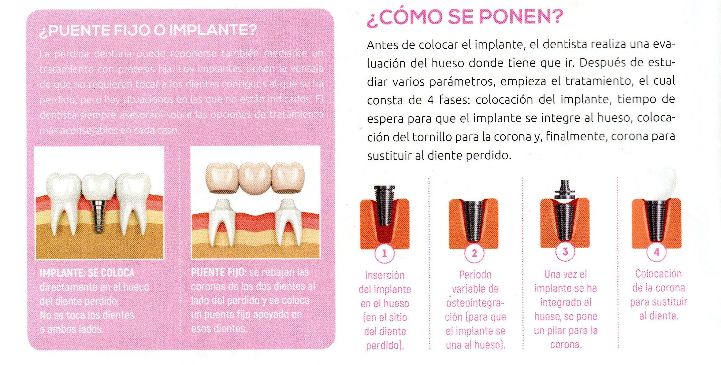 dentista en cadiz javier perez implantes