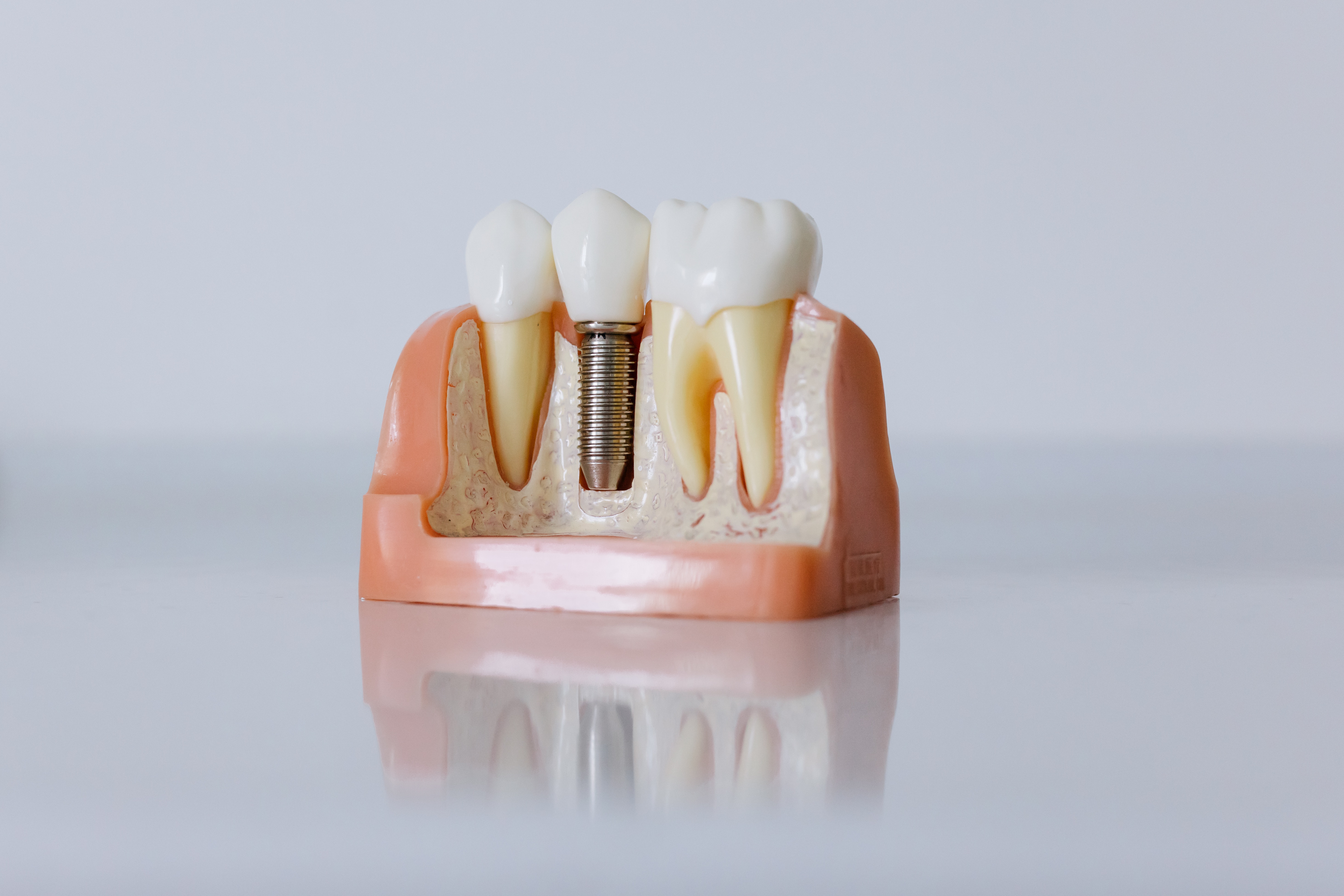 Implantes dentales en Sevilla Este