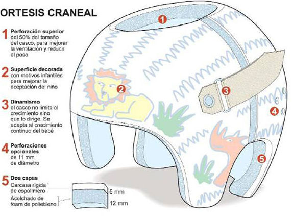 partes de una ortesis craneal