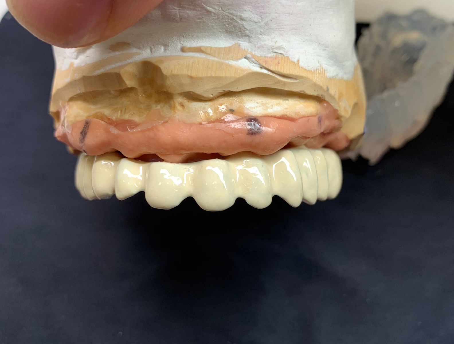 Rehabilitación titanio composite