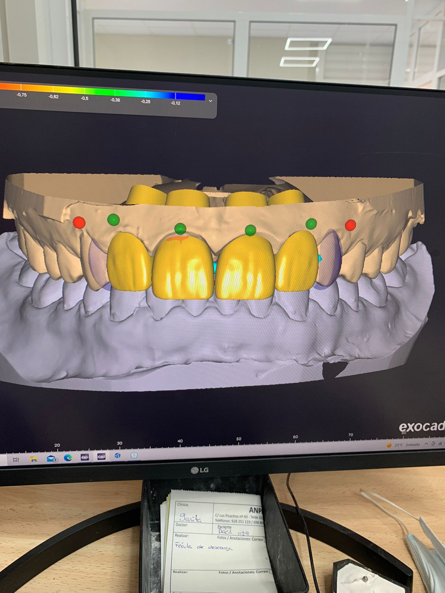 Provisionalidades en resina cetálica diseno cad cam cementados en boca