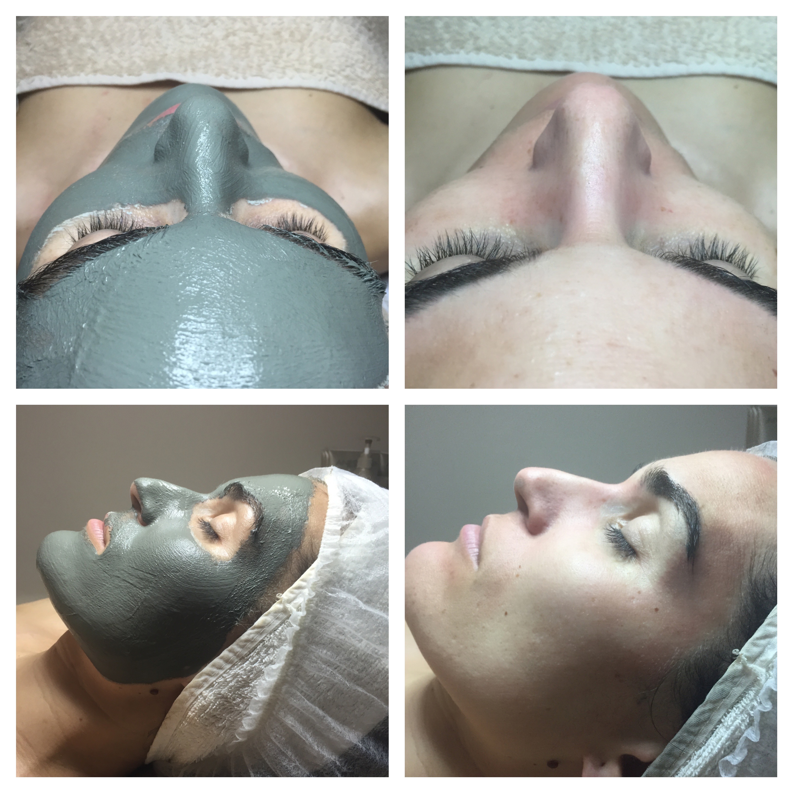 Tratamiento facial en Virginia Guerrero