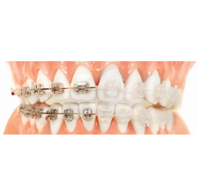 Ortodoncia Invisalign en Sant Feliu de Llobregat