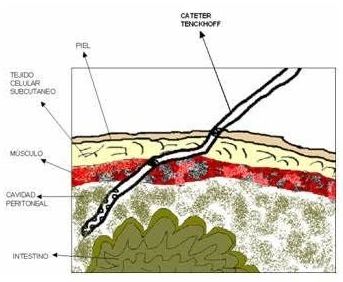 Colocación del catéter de diálisis peritoneal