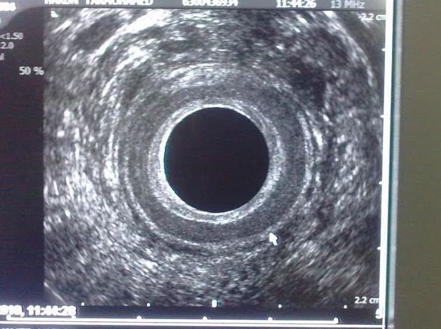 Ecografía endoanal - En estos momentos no podemos facilitar el servicio de esa prueba