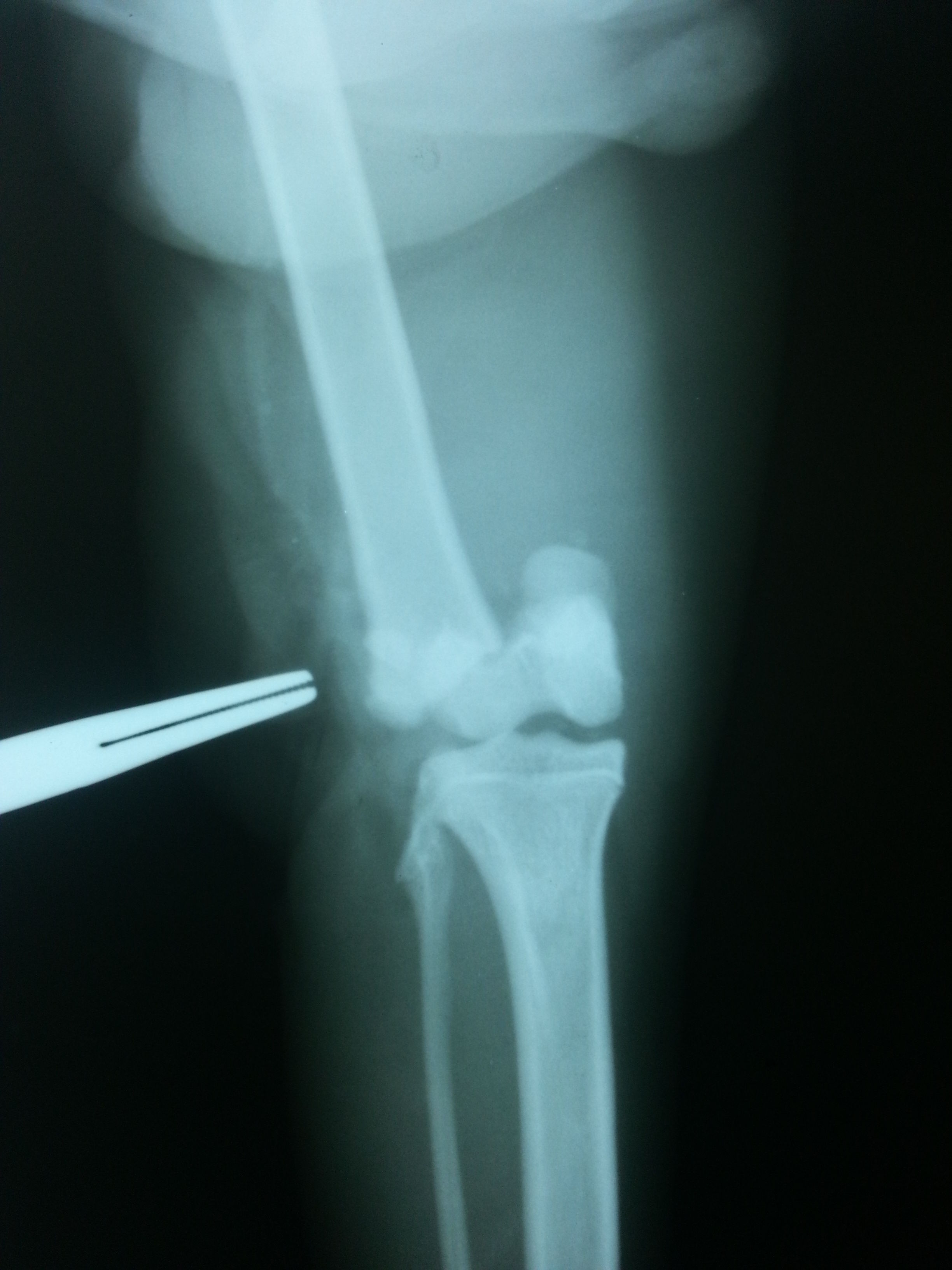 FRACTURA EPIFISIS DISTAL DEL FÉMUR,FOTO 1