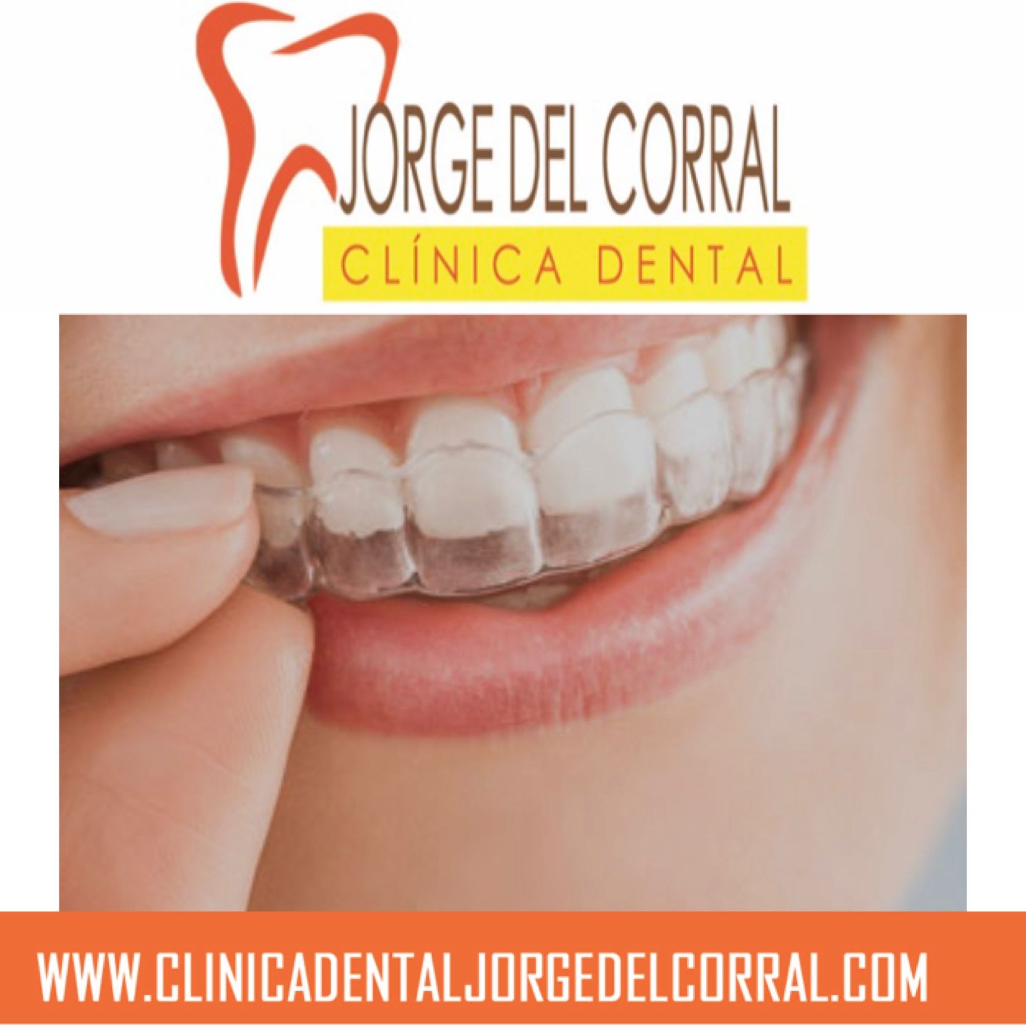 Ortodoncia invisalign Hortaleza Canillas