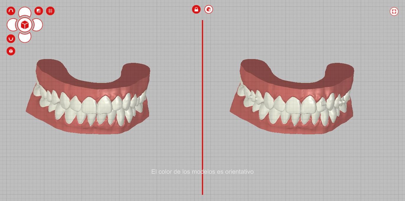 ORTODONCIA MADRID-DISEÑO DE SONRISA MARID-CLINICA DENTAL MADRID