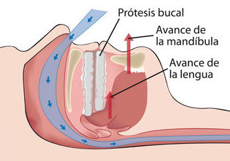 Dispositivo avance mandibular en Madrid, la solución a los trastornos del sueño