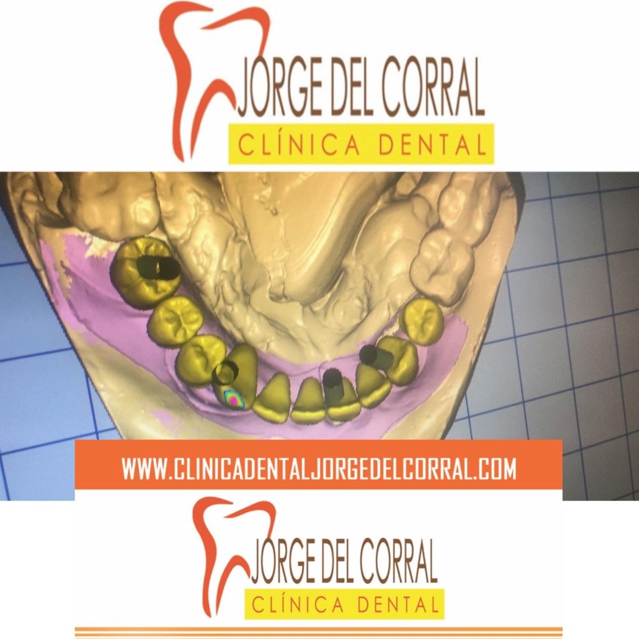 Cirugía guiada de implantes dentales por ordenador en Madrid