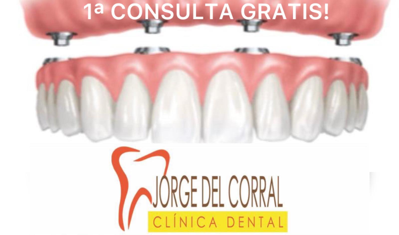 SOBREDENTADURA + 4 IMPLANATES, IMPLANTES DENTALES HORTALEZA MADRID