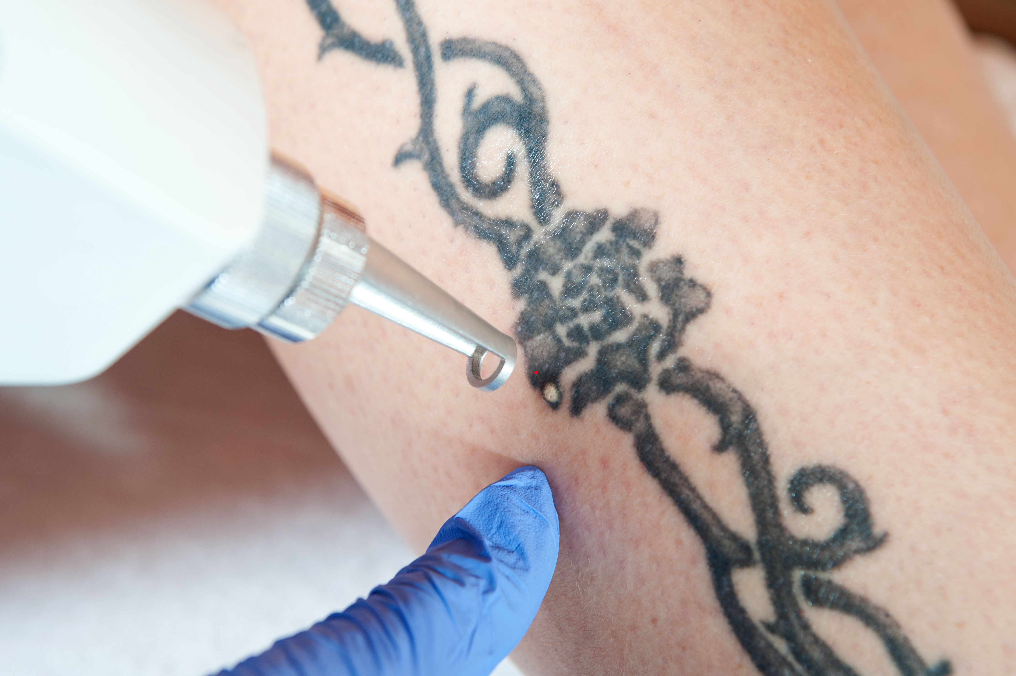 Eliminaciónm de tatuajes en Santa Cruz de Tenerife