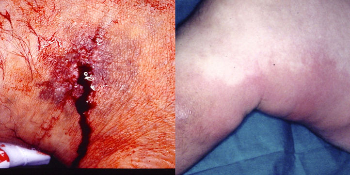 Varices: complicaciones