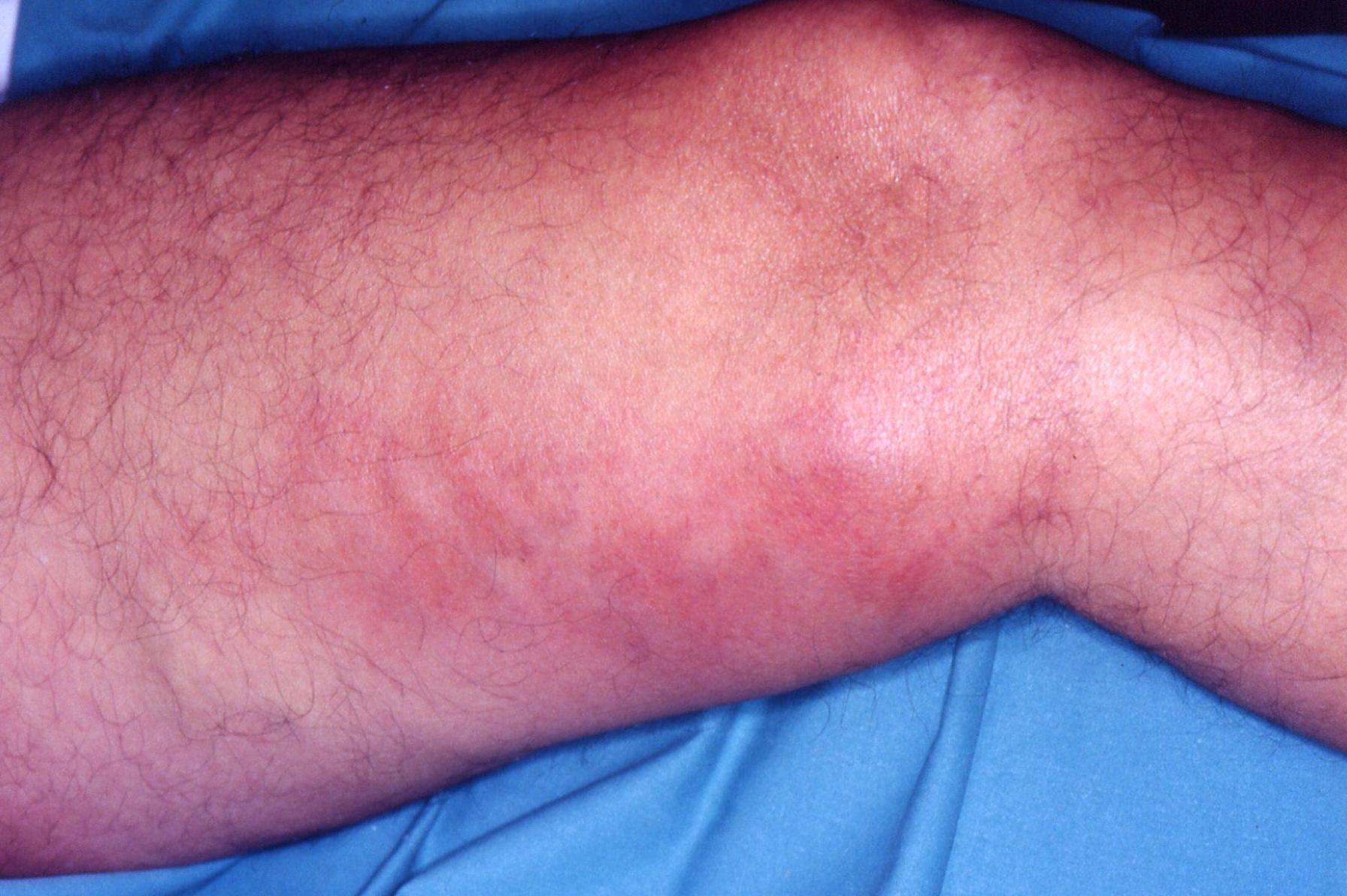 Flebitis