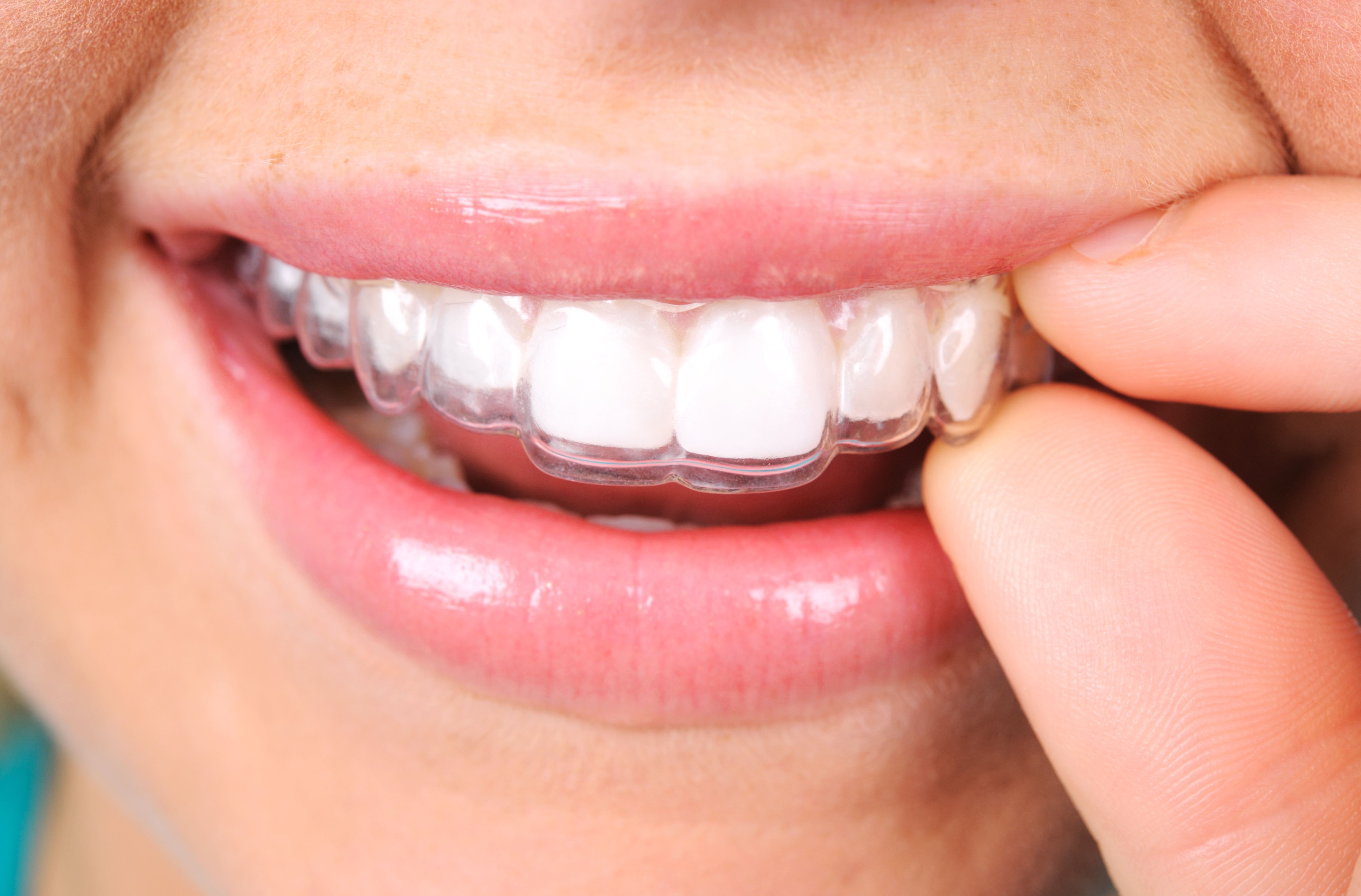 Ortodoncia invisalign en Cornellá de Llobregat