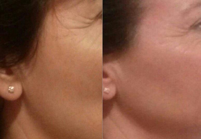 Resultados tras una sesión de lipoled