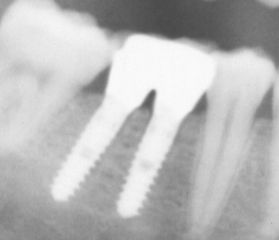 Implantes dentales
