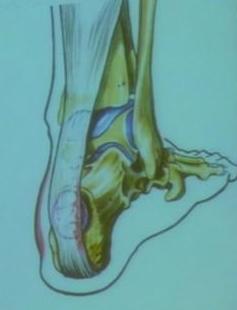 Bursitis Aquílea