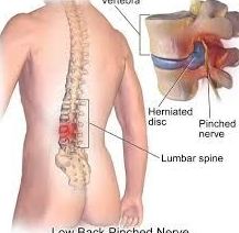 ¿Qué es una hernia discal? ¿Cuáles son sus síntomas y sus causas?