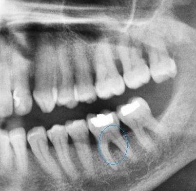 Enfermedad periodontal