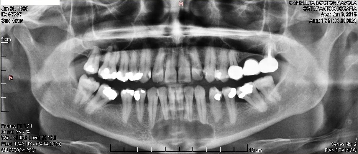 Caso Clínico de un Quiste Folicular