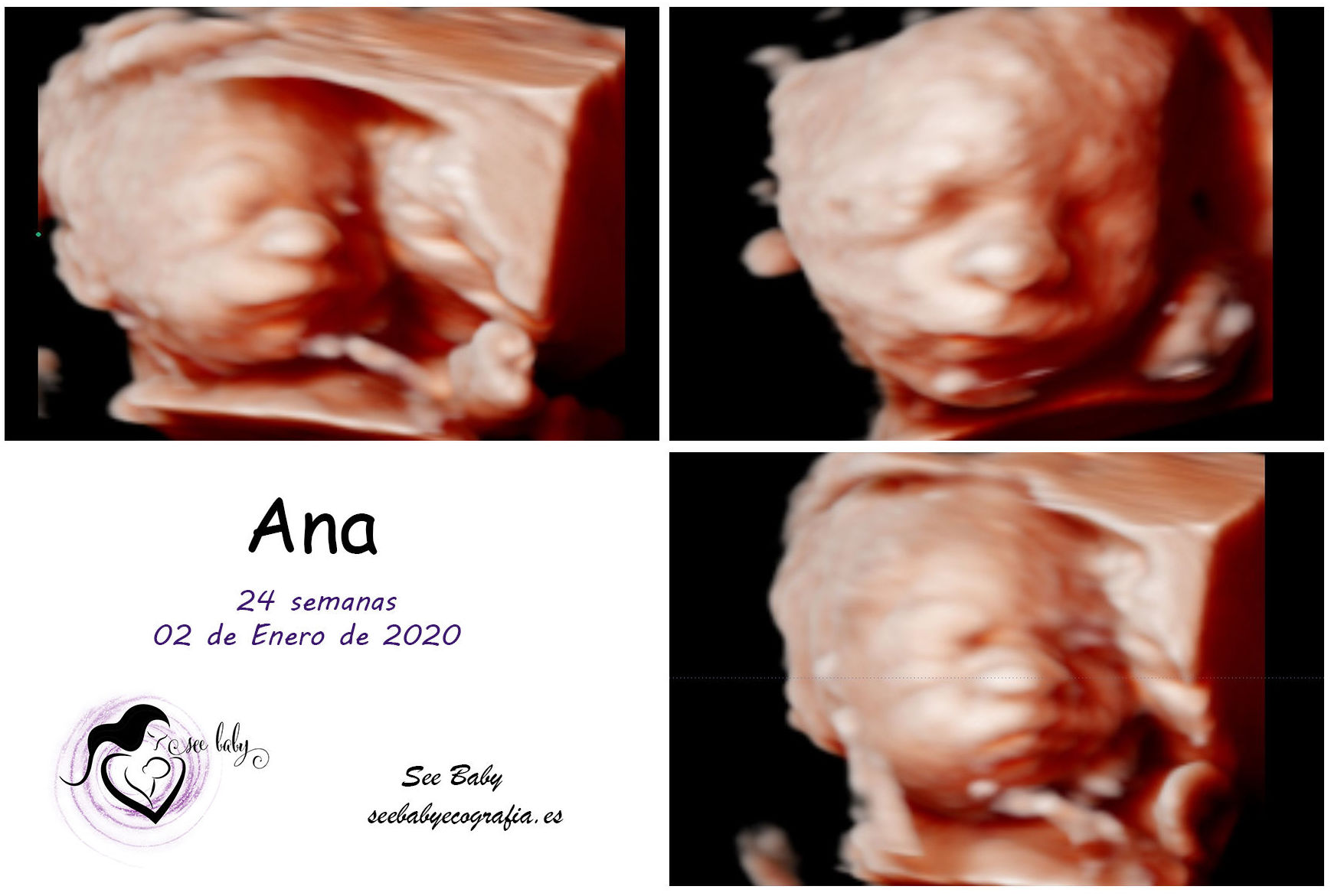 Querida Ana - SeeBaby Ecografia 5D