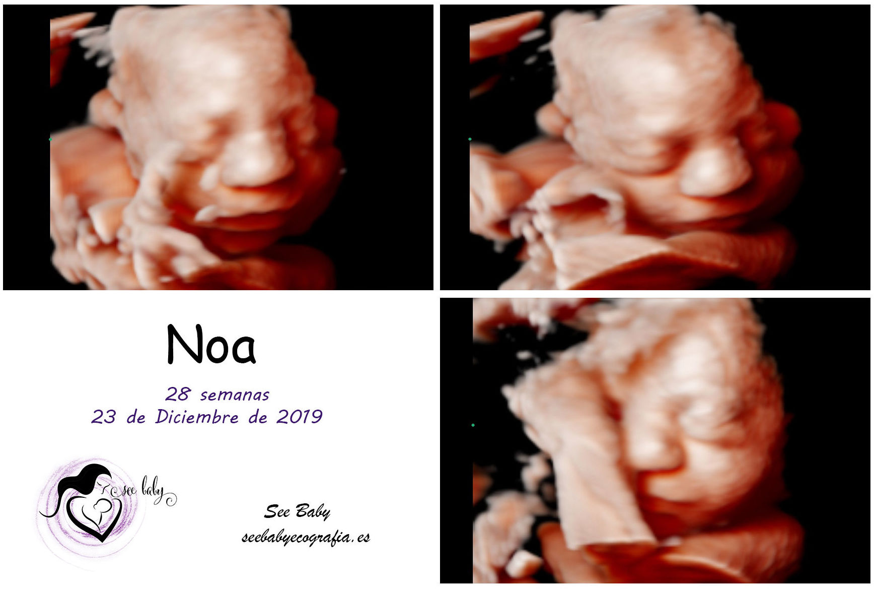 Noa en SeeBaby Ecografia 5D