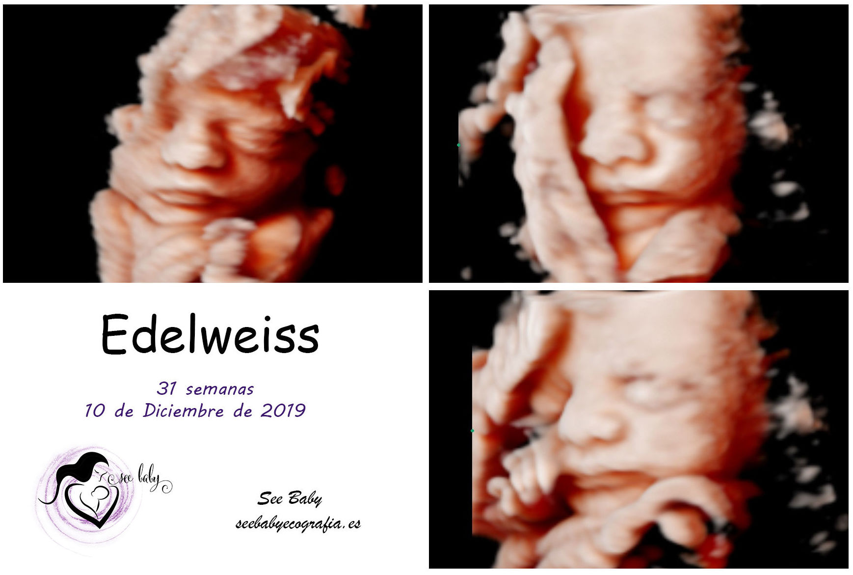 Querida Edelweiss en SeeBaby Ecografia 5D