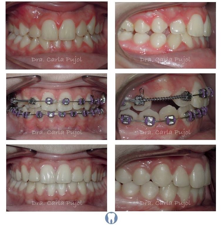 Paciente rehabilitado con ortodoncia sin necesidad de extracciones.