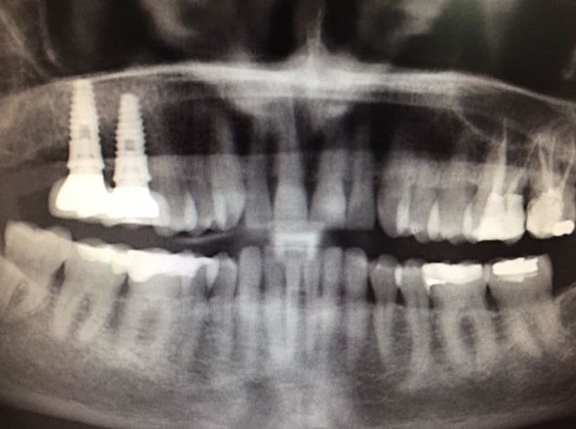 ¡CASO REAL! Implantes Dentales Biorizons con pilares multiunit