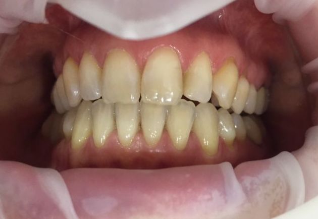 Blanqueamiento dental en consulta con solo dos sesiones y sin sensibilidad
