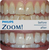 Promoción Blanqueamiento Zoom de Philips