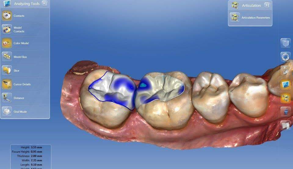 Odontologia CAD-CAM en clínica.