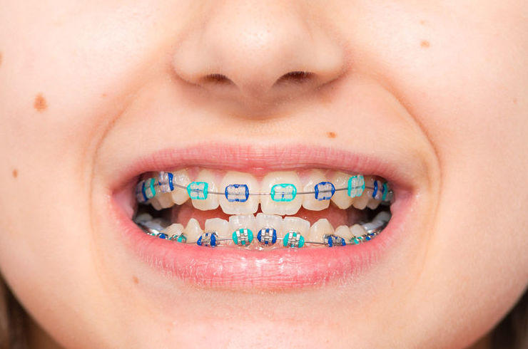 Ortodoncia niños hortaleza