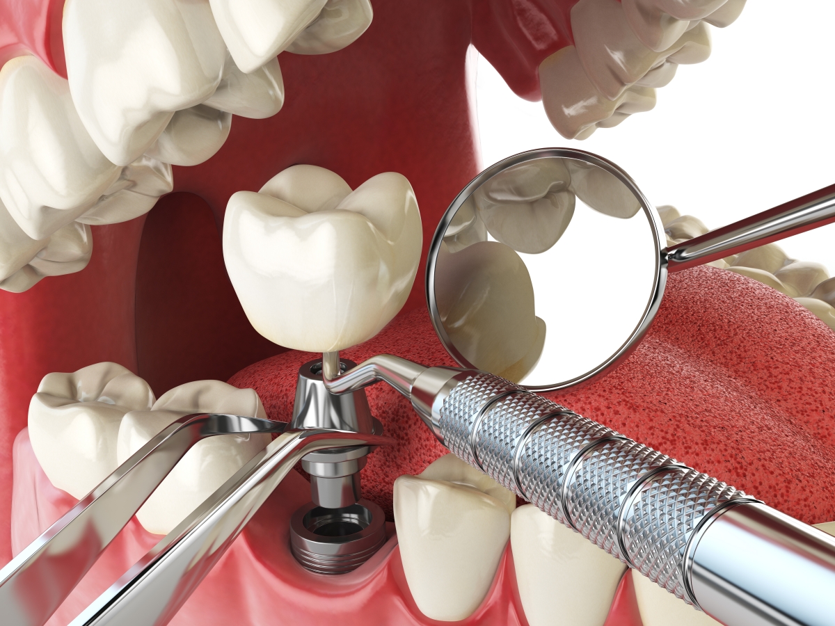 Cuidados de los implantes dentales.