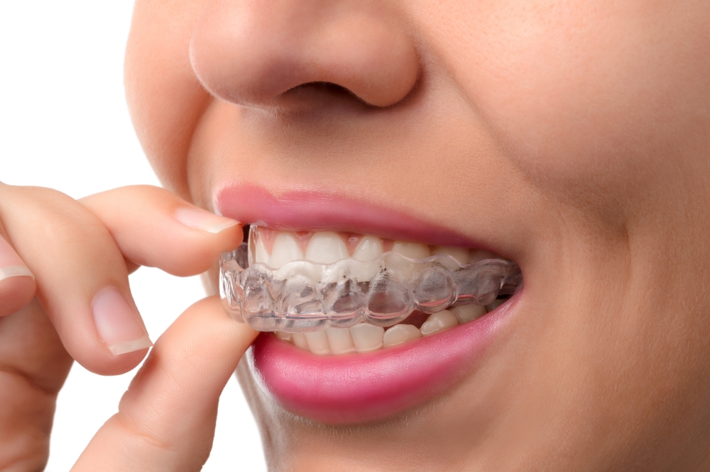 Ortodoncia invisalign