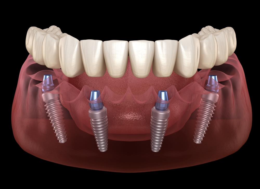 Implantes dentales