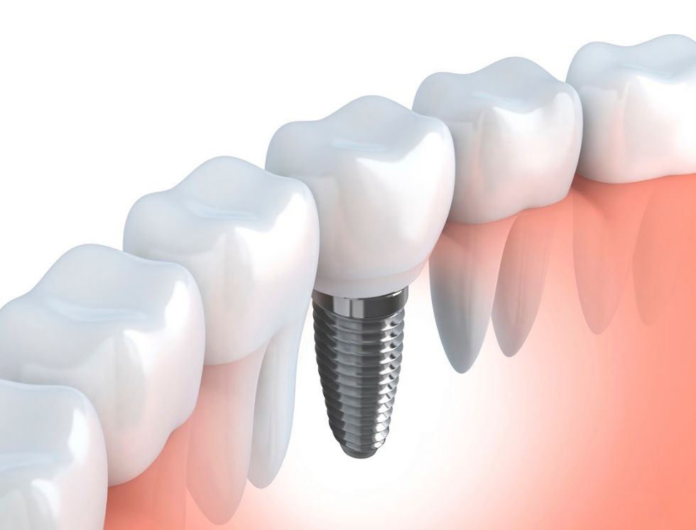 Implantes dentales