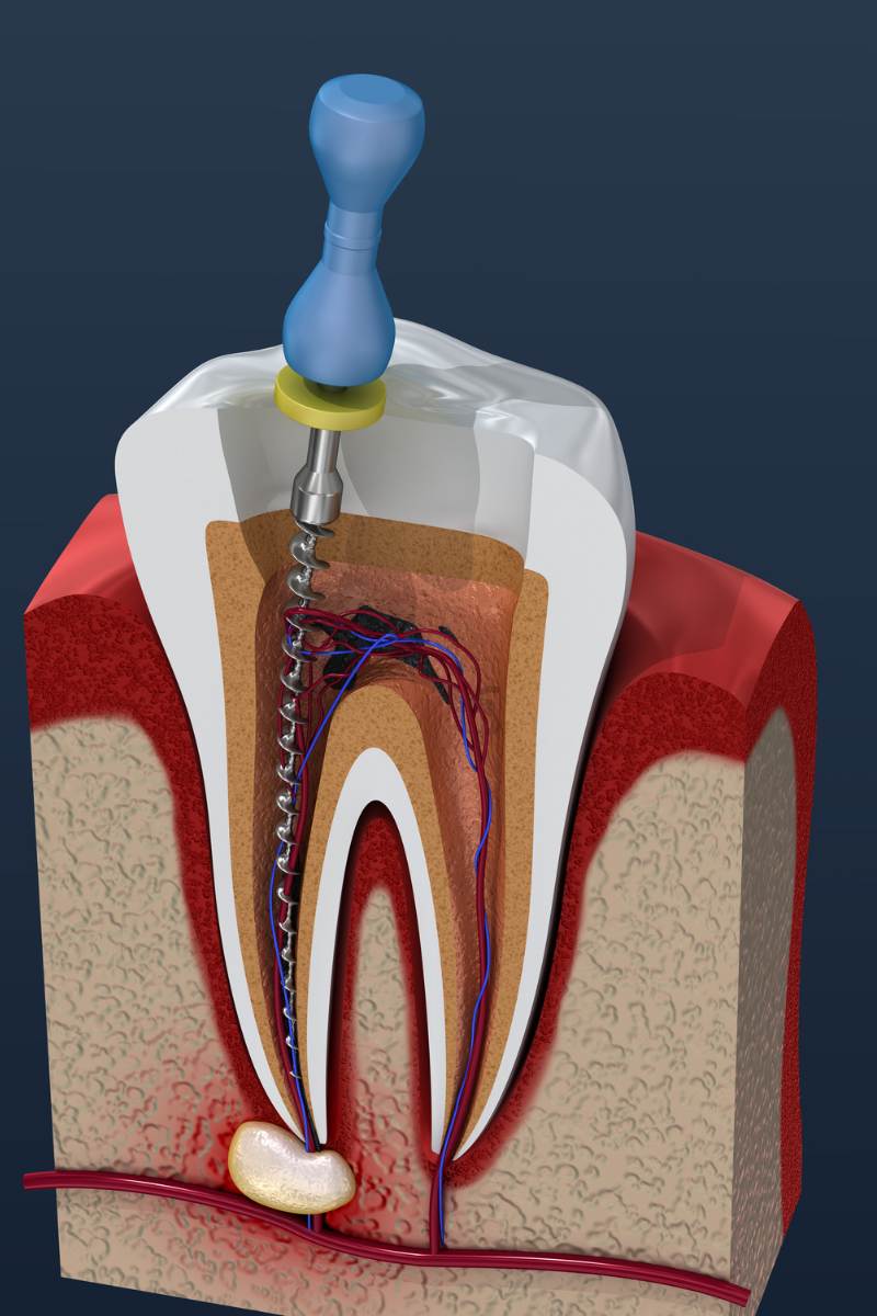 Endodoncia