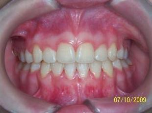Ortodoncia adultos