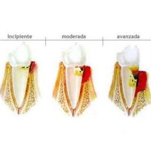 Periodoncia