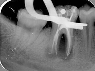 Endodoncia microscópica