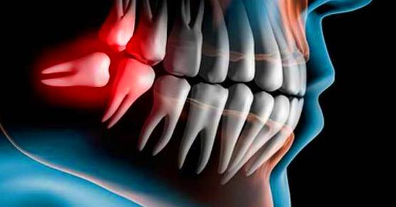 CIRURGIA ORAL