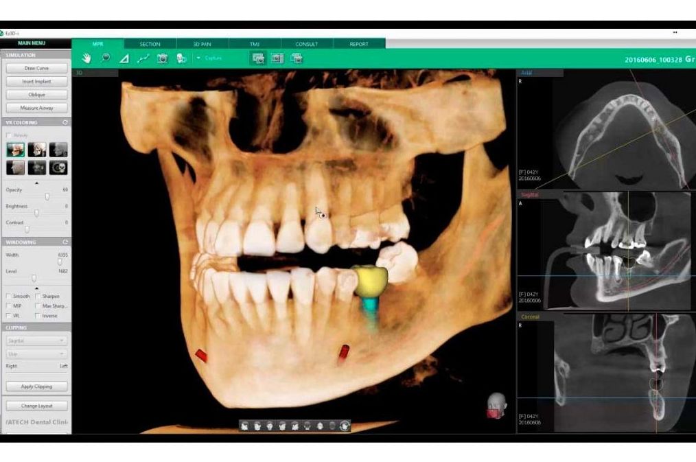 TAC - Radiografías en 3D