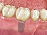 Implantes dentales