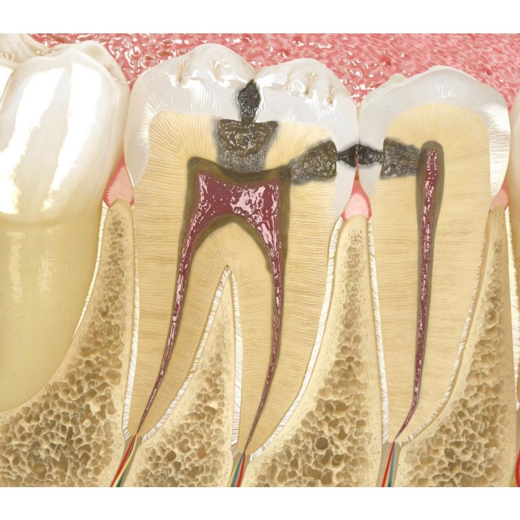 Endodoncia