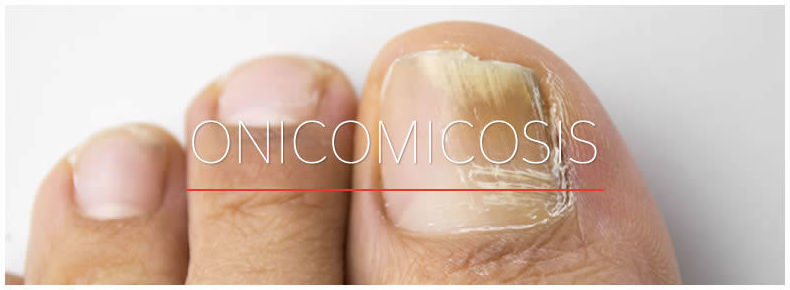 Test de detección rápida de Onicomicosis (Hongos en las uñas)