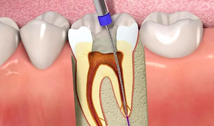 Endodoncia